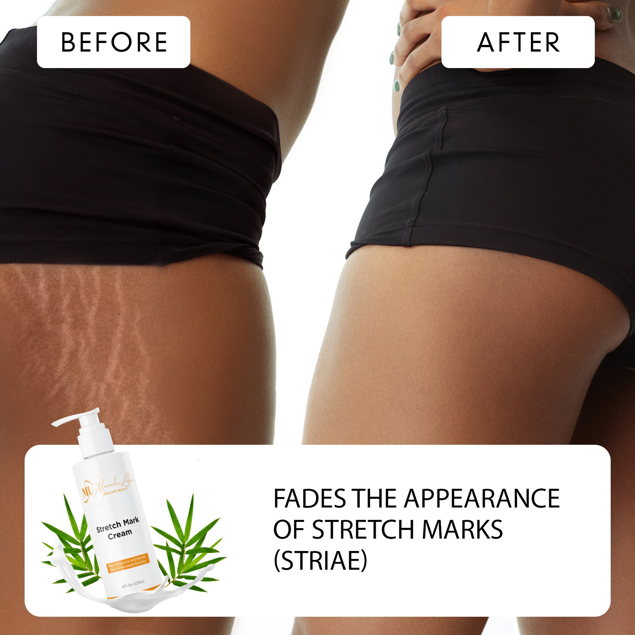 Stretch Mark Cream Skin Treatment Moisturizing Reduces Inflammation Prevents Future Marks Safe for All Skin Types